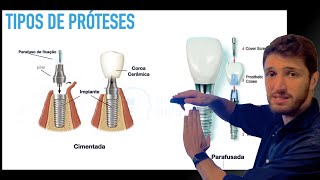 Tipos de prótese em Implantodontia  Cimentadas Parafusadas Unitárias ou Múltiplas [upl. by Ahseinek]