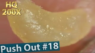 18 Push OutSqueezingBlackheads Close up 200X  ピンセットで角栓を押し出し除去 [upl. by Rosenkrantz]