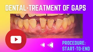 quotHow Acid Erosion Causes Tooth Sensitivity Prevention and Treatment Tipsquot 🦷 shorts dentist [upl. by Rehpotsirc]