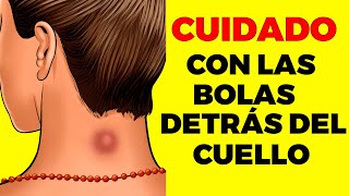 BOLA DETRÁS DEL CUELLO ¿Por qué sale y cuando ir al doctor [upl. by Evelc27]