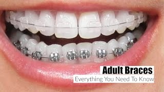 Adult Braces Everything You Need To Know MissLizHeart [upl. by Dhruv]