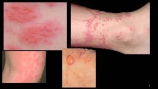 Contact Dermatitis [upl. by Egdirdle]