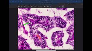 Pathology L4 C1C2 Thyroid gland P3 [upl. by Assadah130]