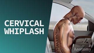 Cervical Whiplash  Trauma [upl. by Neelyt742]