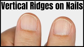 Vertical Ridges on Nails Causes Signs and Treatment [upl. by Nnuahs]