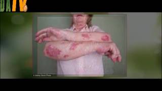 New spray on foam treatment can clear psoriasis in less than a month [upl. by Sjoberg]