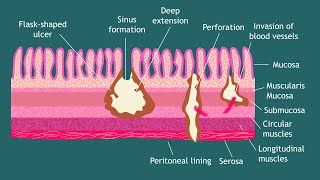 Pathogenesis of Entamoeba histolytica Notes  Parasitology  Basic Science Series [upl. by Ajdan]