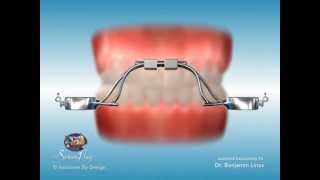 ScreenPlay Orthodontic Education Videos Rapid Palatal Expander RPE [upl. by Derfliw969]