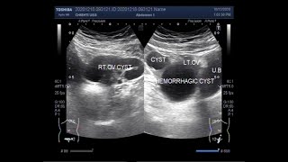 Ultrasound Video showing Ovarian Cysts simple Hemorrhagic and complex ones all in one patient [upl. by Concordia]