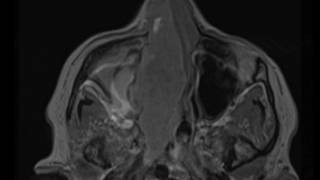 Sinonasal Squamous Cell Carcinoma [upl. by Enneirda]