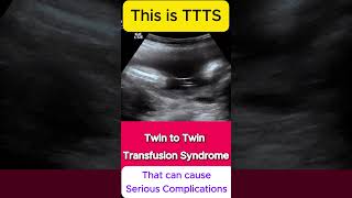 TTTS  Twin to Twin Transfusion Syndrome Ultrasound  Monochorionic TWINS [upl. by Refiffej]