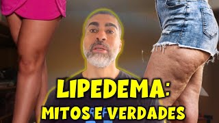 Lipedema mitos e verdades [upl. by Subak]