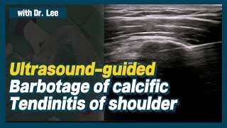 TrailerUltrasoundguided lavage of calcific tendinitis of shoulder ruptured calcification [upl. by Nivlak]