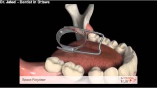 Space Regainer  Ottawa Dentists [upl. by Latreshia]