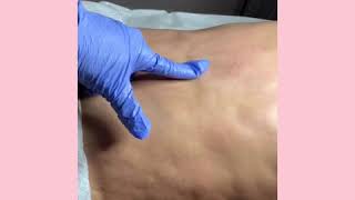 Fibrosis Treatment after liposuction [upl. by Pogue]