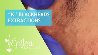 Blackheads Extractions “K’s” 2nd Treatment [upl. by Motteo663]