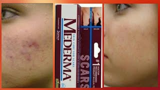 Mederma skin cream review  Scar ointment gel Mederma [upl. by Herta239]