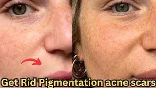 Get rid of pigmentation dark spots scars amp pimplesGet Rid Dark amp Dry skinaliyanalizafamily [upl. by Coridon]