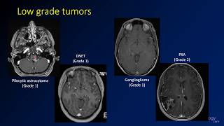 Imaging CNS autoimmune and inflammatory disease  1  IntroductionDemyelinating disease [upl. by Amadeo]