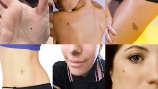 What The Position Of Your Birthmark SAYS About You [upl. by Ahsad]