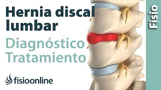 Hernia discal lumbar programa de ejercicios para la fase avanzada [upl. by Gautier]