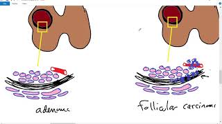 Systemic pathology 30  Endocrine 3  thyroid tumors  DRSAMEH GHAZY [upl. by Germin587]