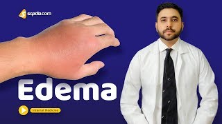 Edema  Medicine Video Lectures  Medical Student Education  VLearning  sqadiacom [upl. by Kovacev]