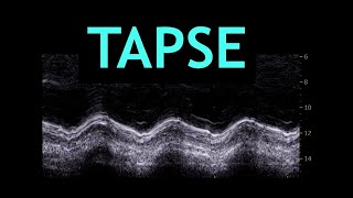 All about TAPSE Echocardiography [upl. by Andrei104]