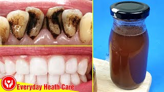 No Need For A Dentists Advice Remove Plaque And Tartar With Only These 3 Ingredients [upl. by Anyala271]