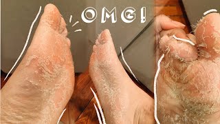 QUARANTINE SELF CARE  Foot Peel Mask in Self Isolation DID IT WORK [upl. by Alia]