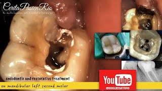 root canal treatment on mandibular molar  perawatan gigi berlubang saluran akar dokter gigi [upl. by Otreblanauj]