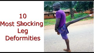 10 Most Shocking Leg Deformities [upl. by Crystal]