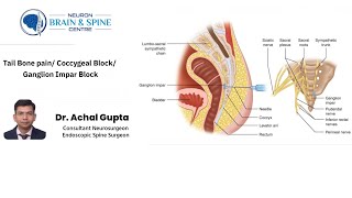 Tail bone pain Coccygeal block Ganglion Impar block  Dr Achal Gupta  Neuro amp Spine Surgeon [upl. by Nonnah]