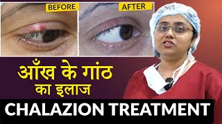 पलक की गाँठ का इलाज  Chalazion क्लेजियन Treatment  Eyelid Cyst Removal Procedure [upl. by Dyrrej]