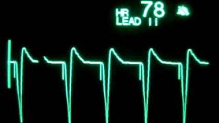 Ventricular Pacing [upl. by Lorak]