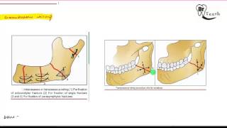 Mandibular Fractures  Part 2 MANAGEMENT [upl. by Ragse]