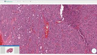 THYROID CARCINOMA How To DIAGNOSE amp TREAT  Neck swellings [upl. by Nnorahs]