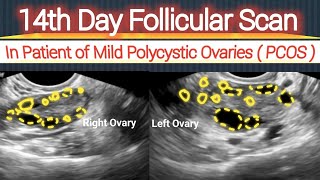 14th Day Follicular Scan  in Patient of Mild Polycystic Ovaries  PCOS [upl. by Aicilihp630]