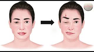 Treatment of Hemifacial Spasm amp Benign Essential Spasm with Botulinum Toxin Injections in India [upl. by Asil]