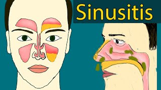 Sinusitis  Symptoms and treatment Sinus Infection Chronic sinusitis [upl. by Ardnasac]