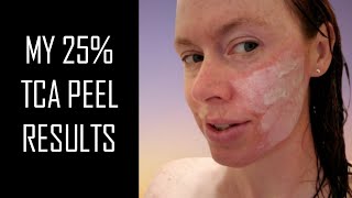 25 TCA PEEL RESULTS  For Freckles Hyperpigmentation amp Acne Scarring [upl. by Meredi]