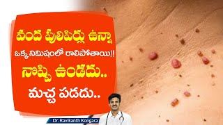 A solution to Remove Warts  Warts on Face and Neck  Pulipirlu  Dr Ravikanth Kongara [upl. by Aratihc]