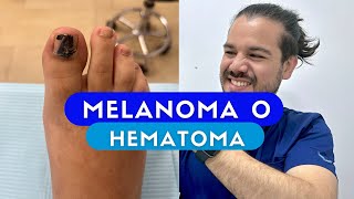 ¿Melanoma subungueal Caso interesante [upl. by Nitsruk]