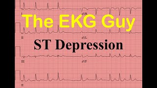 EKGECG STsegment Depression  Question 150  The EKG Guy [upl. by Eerat]