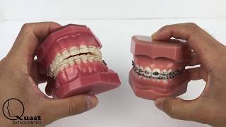 Ceramic Braces vs Metal Braces [upl. by Iatnahs303]