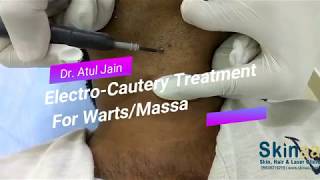 WartsMole Removal Treatment with Electrocautery in Jaipur India – Dr Atul Jain [upl. by Milicent25]