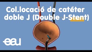 Collocació de catéter doble J [upl. by Nedroj289]