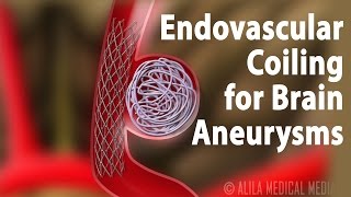 Endovascular Coiling for Brain Aneurysm Animation [upl. by Anoi384]