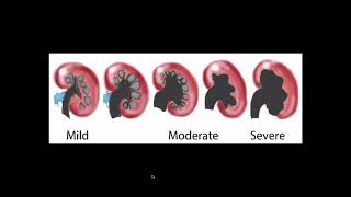 Hydronephrosis  Ultrasound [upl. by Notlil]