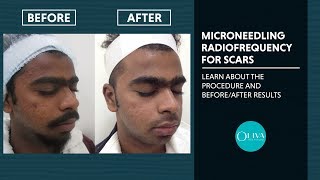 Microneedling RadiofrequencyRF Treatment Before And After Results  Oliva Clinic [upl. by Zebe]